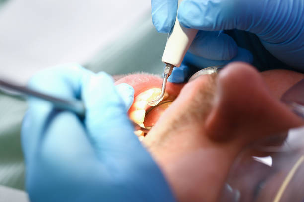 Best Emergency Treatment for Dental Infections or Abscesses in Pitman, NJ