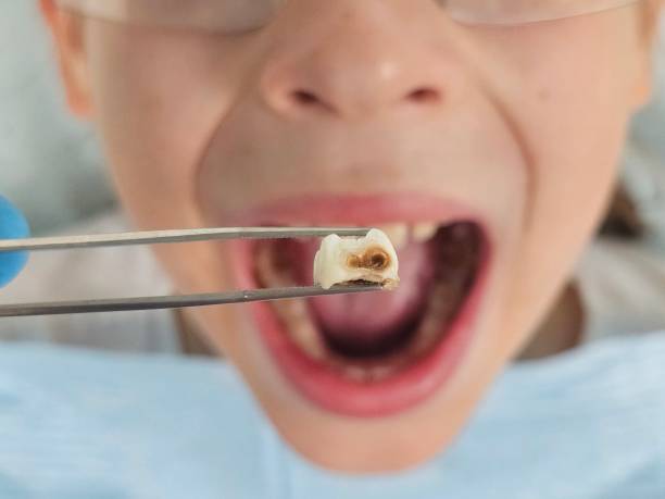 Best Urgent Care for Lost Fillings or Crowns in Pitman, NJ